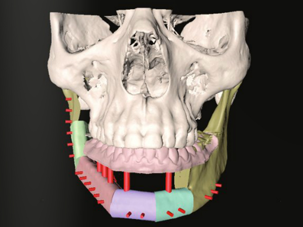Reconstrucción Mandibular y Rehabilitación Implantológica inmediata mediante Planificación Virtual 3D
