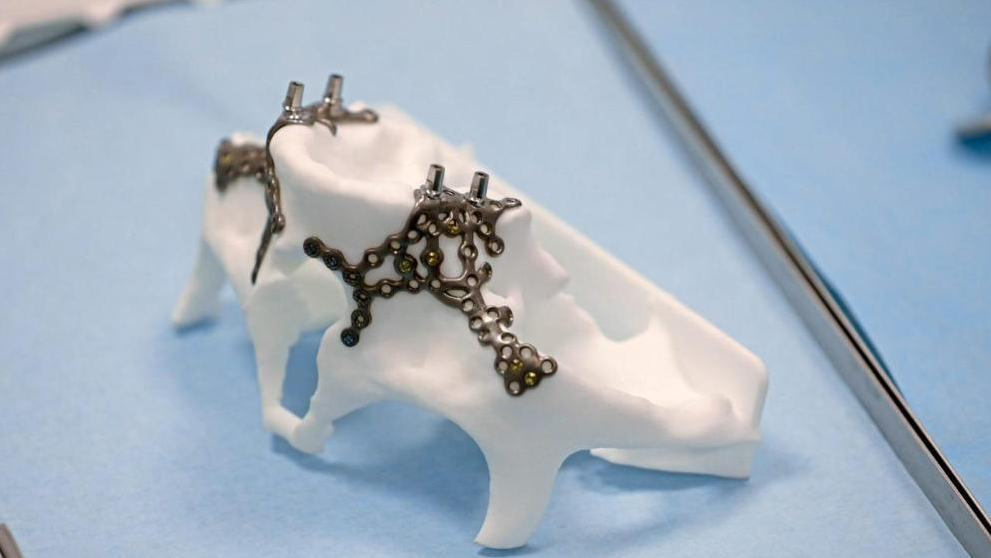Investigadores de la Universidad de Medicina (MHH) de Alemania crean un implante maxilar de titanio