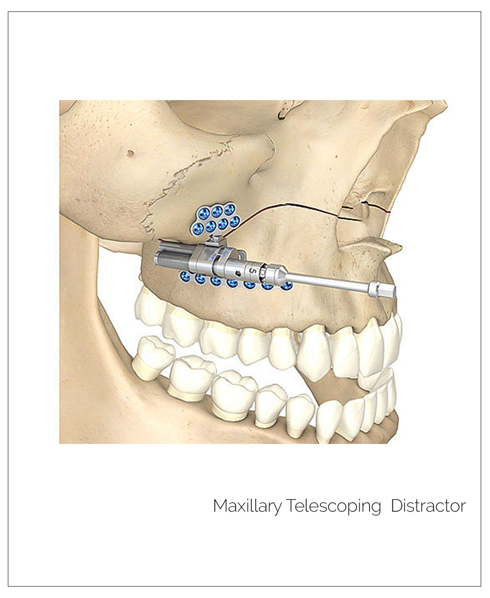 Distractores. Midface