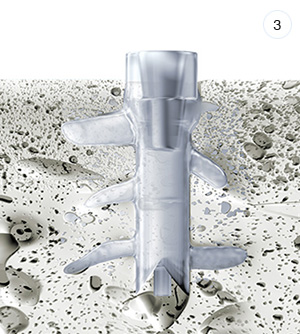 SISTEMA SONICWELD-RX<sup>®</sup> EN 4 PASOS SISTEMA SONICWELD-RX<sup>®</sup> EN 4 PASOS
