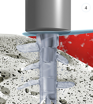 SISTEMA SONICWELD-RX<sup>®</sup> EN 4 PASOS SISTEMA SONICWELD-RX<sup>®</sup> EN 4 PASOS